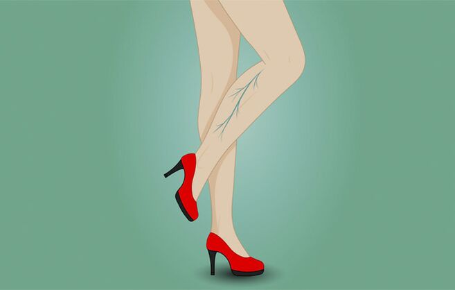 Varices dans les jambes d'une femme