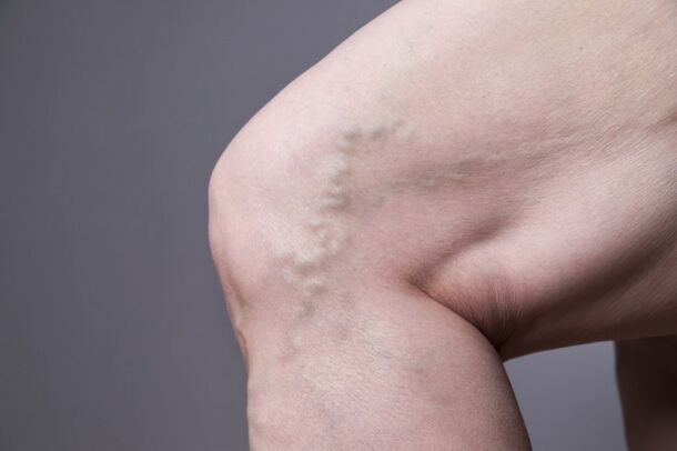 Varices chez les femmes