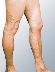 Varices sur les jambes d'un homme.