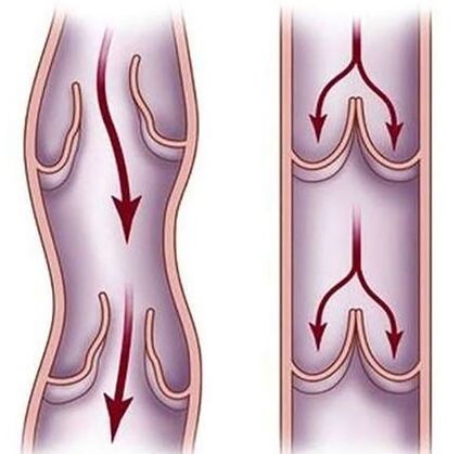 Varices