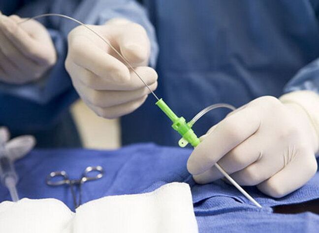 ablation par radiofréquence