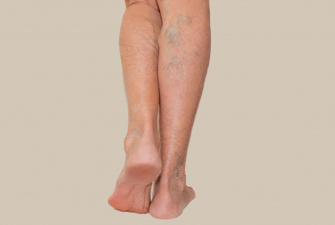 varices dans les jambes