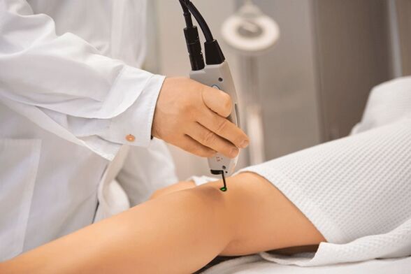 Coagulation laser des veines des membres inférieurs.