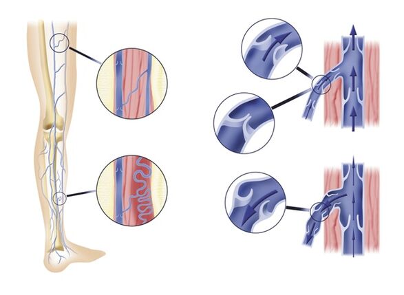 Des valvules veineuses incompétentes provoquent des varices