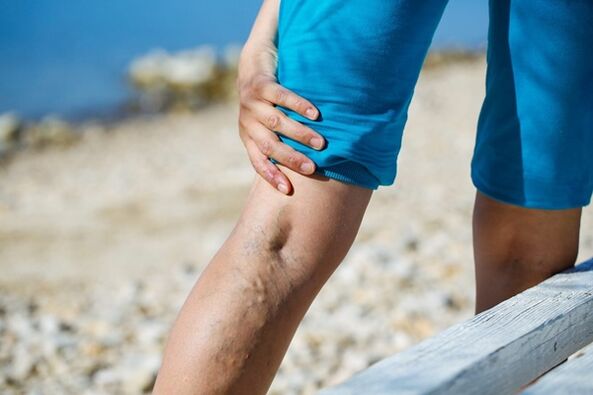 Douleur persistante dans les jambes avec varices.