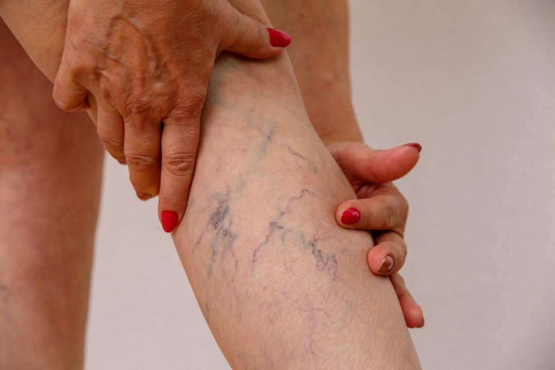 varices sur les jambes